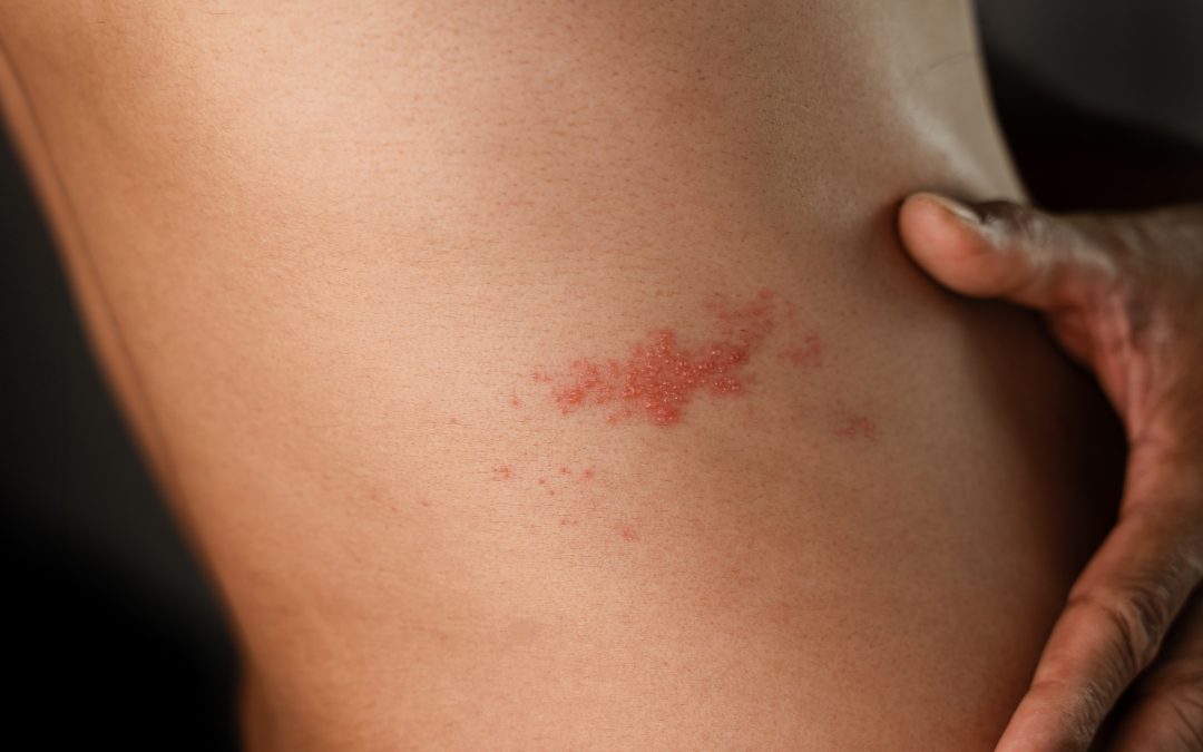 2nd shingles vaccine not picked by CQRS